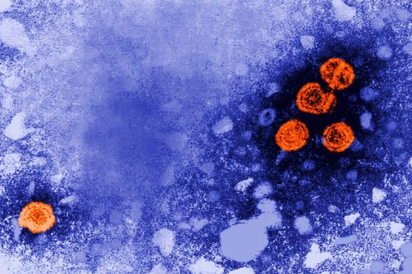 Esta imagen de microscopio de electrones de 1981 publicada por los Centros de Control y Prevención de Enfermedades de Estados Unidos mientras partículas del virus de la hepatitis B, indicadas en naranja. (Dr. Erskine Palmer/CDC via AP, Archivo)