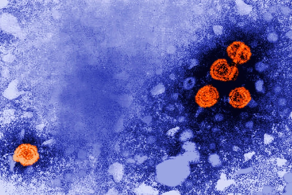 Esta imagen de microscopio de electrones de 1981 publicada por los Centros de Control y Prevención de Enfermedades de Estados Unidos mientras partículas del virus de la hepatitis B, indicadas en naranja. (Dr. Erskine Palmer/CDC via AP, Archivo)
