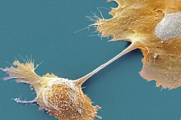 Perú: operan con éxito a una mujer con los órganos invertidos para extirparle un tumor pancreático